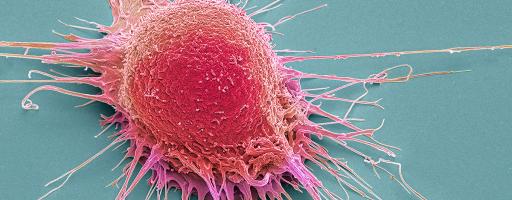 Prostate cancer cell, coloured scanning electron micrograph (SEM)